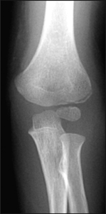 Fracture_Lateral condyle_Figure 1_1132801-Lateral-condyle-undisplaced AP.jpg Fracture_Lateral condyle_Figure 1_1132801-Lateral-condyle-undisplaced AP.jpg